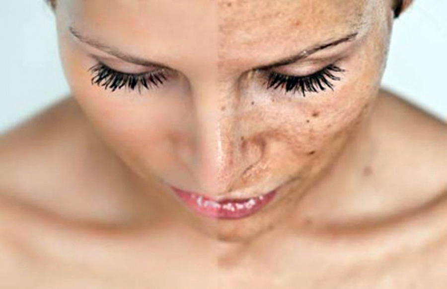 Як прибрати пігментні плями на обличчі?